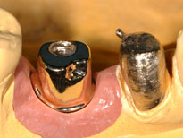 Gold02 Dentallegierung